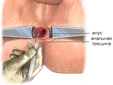 Секс при геморрое (анальный) - можно ли заниматься до и после операции